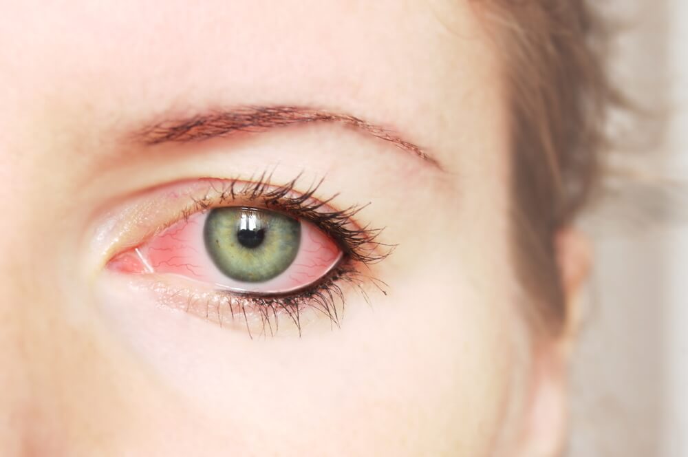 Close up of a left eye. The eye is red and irritated.