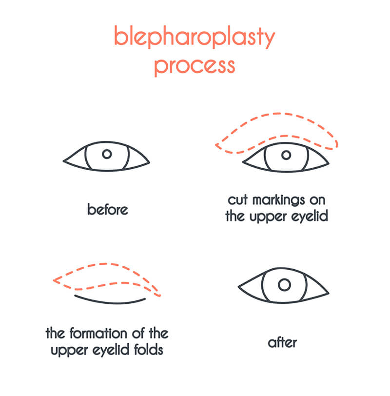 Blepharoplasty Diagram