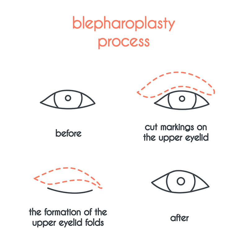 Blepharoplasty Buckhead Blepharoplasty Diagram