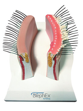 BlephEx® Treatment Example