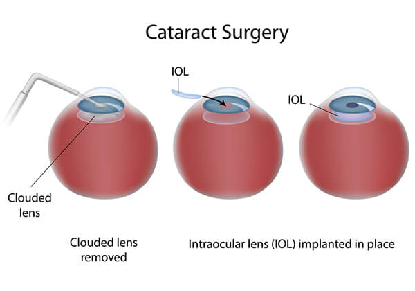 Cataract Surgery procedure diagram