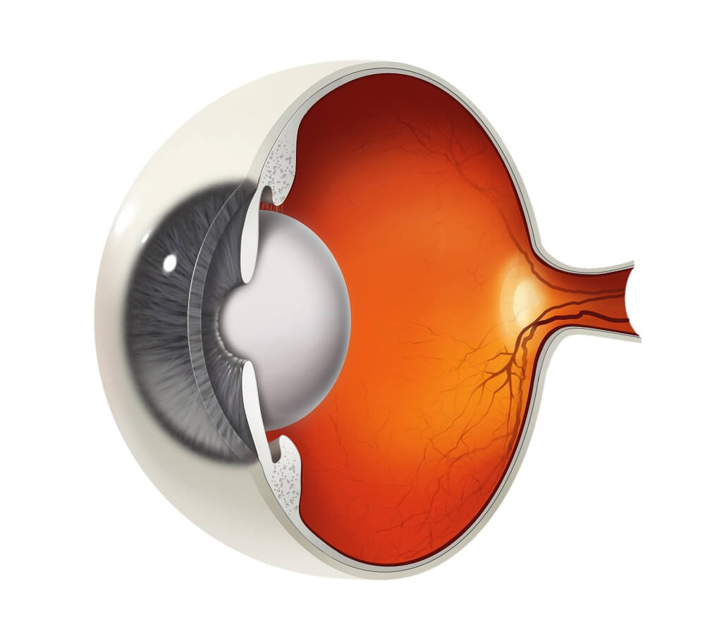 Diagram of an eye with cataracts. The lens that focuses vision is covered in a cloudy, milky film.