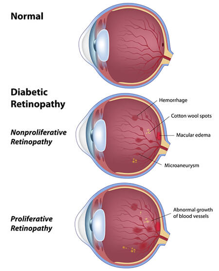 Types of Diabetic Retinopathy Chart
