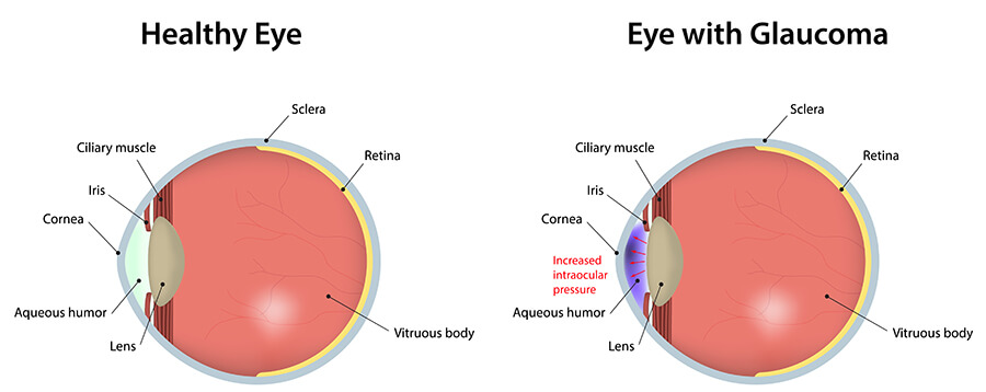 Glaucoma Buckhead Glaucoma Chart