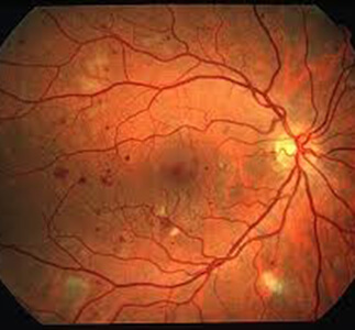 Scan of a retina with Diabetic Retinopathy