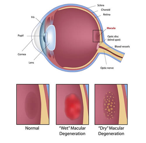 Macular Degeneration Chart Printable