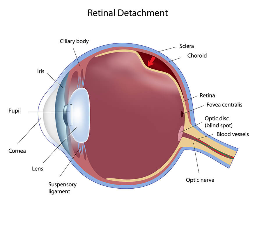 Chart Showing Retinal Detachment