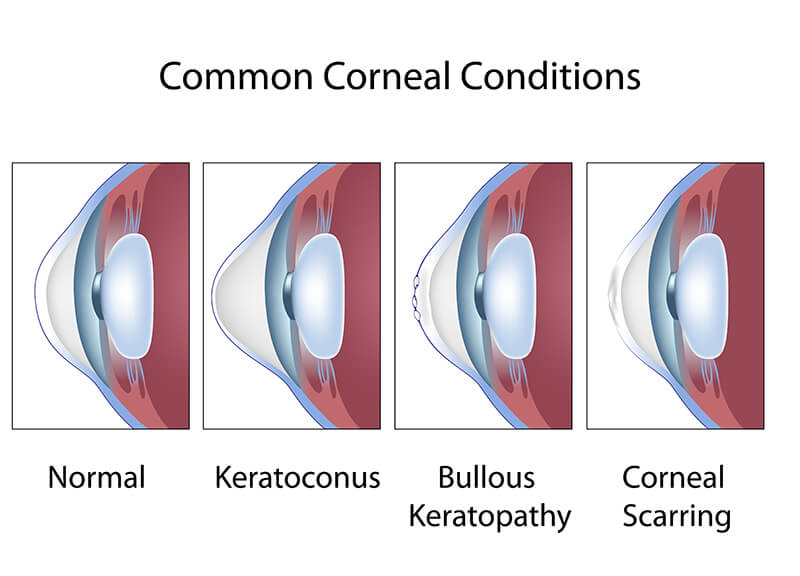 Chart showing Keratoconus and other Corneal Conditions