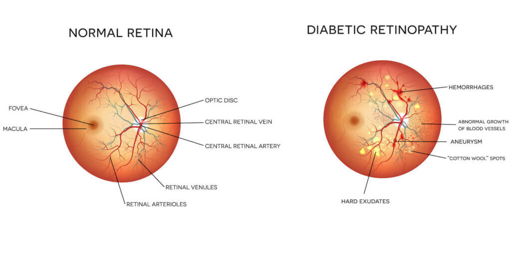 Diagram of diabetic retinopathy vs a normal retina