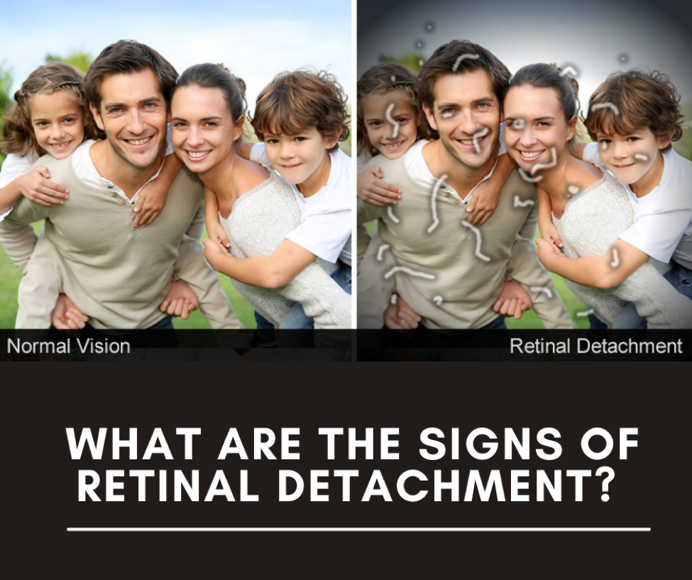 retinal detachment vision